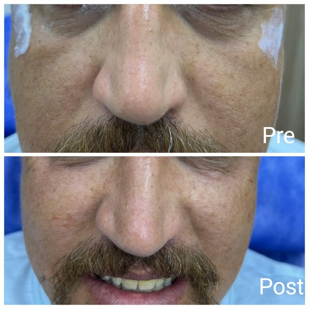 Plasma filler under the eye
